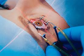 لیزر فیبری در جراحی چشم